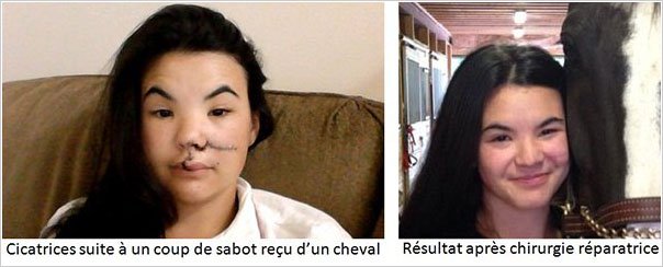 résultat aprés chirurgie réparatrice